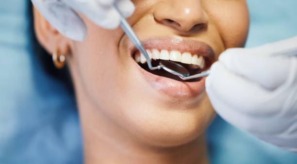 Best Knocked-Out Tooth (Avulsed Tooth) Treatment in Nocatee, FL